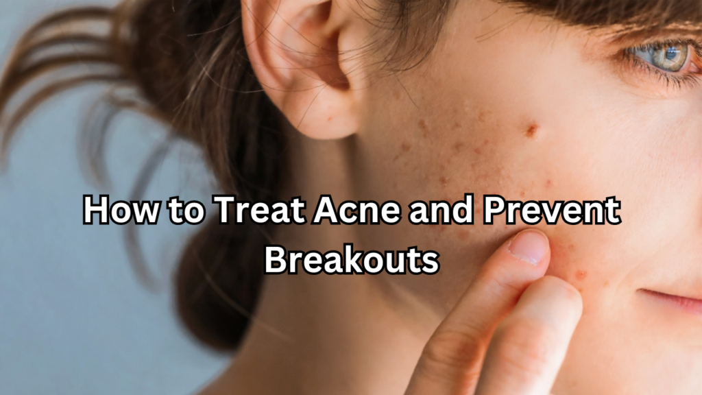 How to Treat Acne